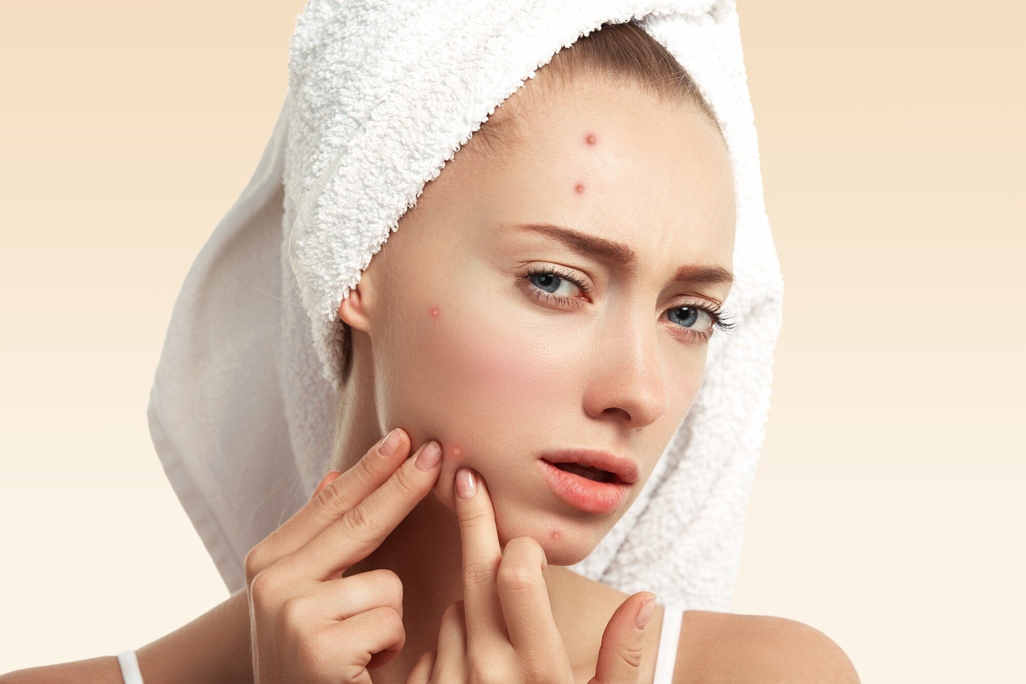 YOUR REFLECTION, YOUR IMAGE, AND SELF-CONFIDENCE: THAT’S YOUR FACE! ACNE: WHAT CAUSES IT, AND HOW CAN YOU SOLVE IT?