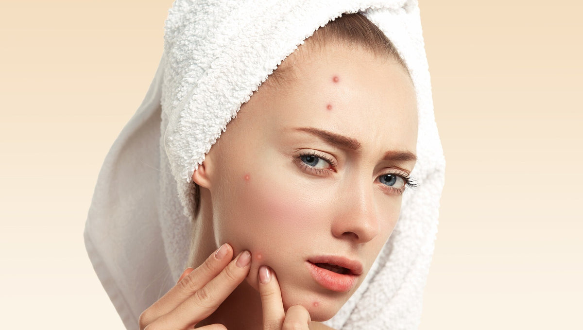 YOUR REFLECTION, YOUR IMAGE, AND SELF-CONFIDENCE: THAT’S YOUR FACE! ACNE: WHAT CAUSES IT, AND HOW CAN YOU SOLVE IT?